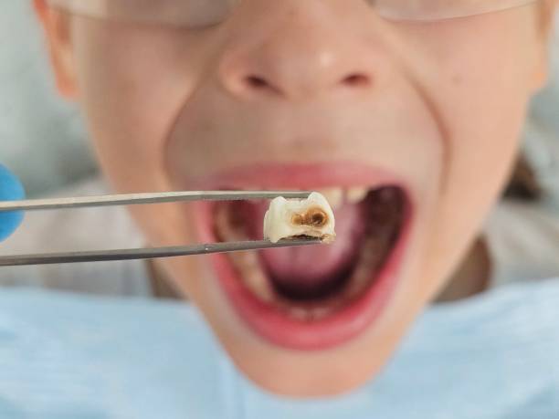 Best Emergency Tooth Extraction in Charlottesville, VA